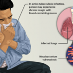 305px-Depiction_of_a_tuberculosis_patient